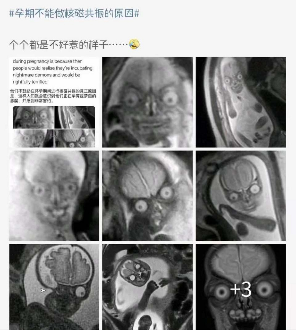 这是真的吗?孕期核磁共振这么恐怖