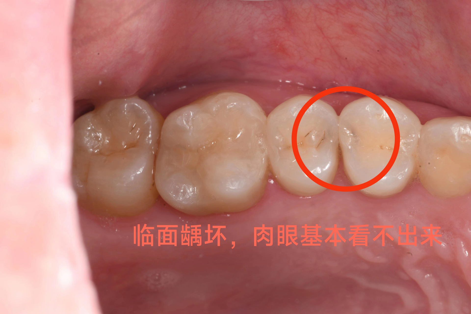 牙齿发现龋坏,就应该及时去把牙齿的龋坏部分磨损掉,给其补上补牙