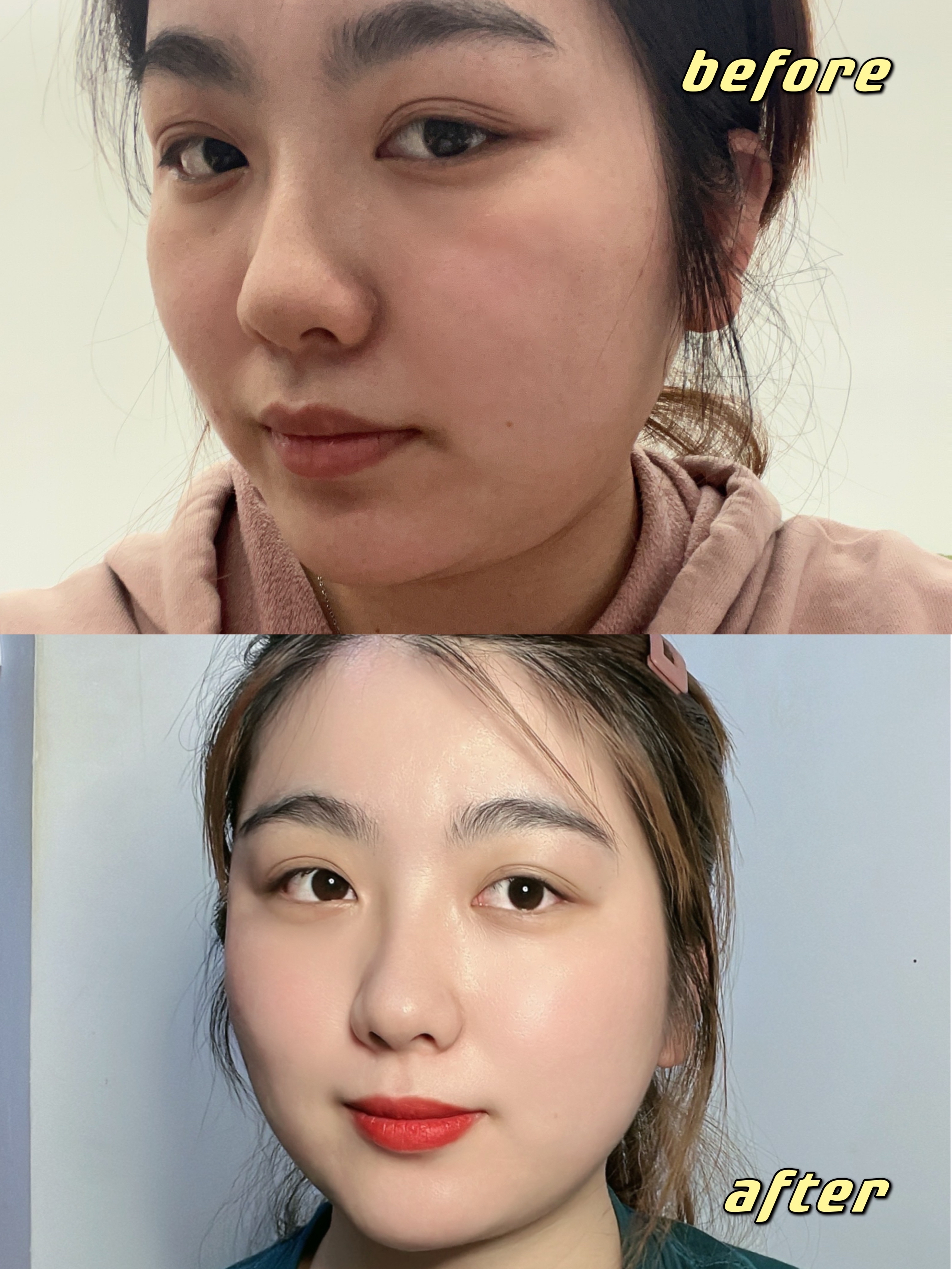 brbr嗨宝子们我在过年之前体验了fotona4d 我觉得这是面部年轻