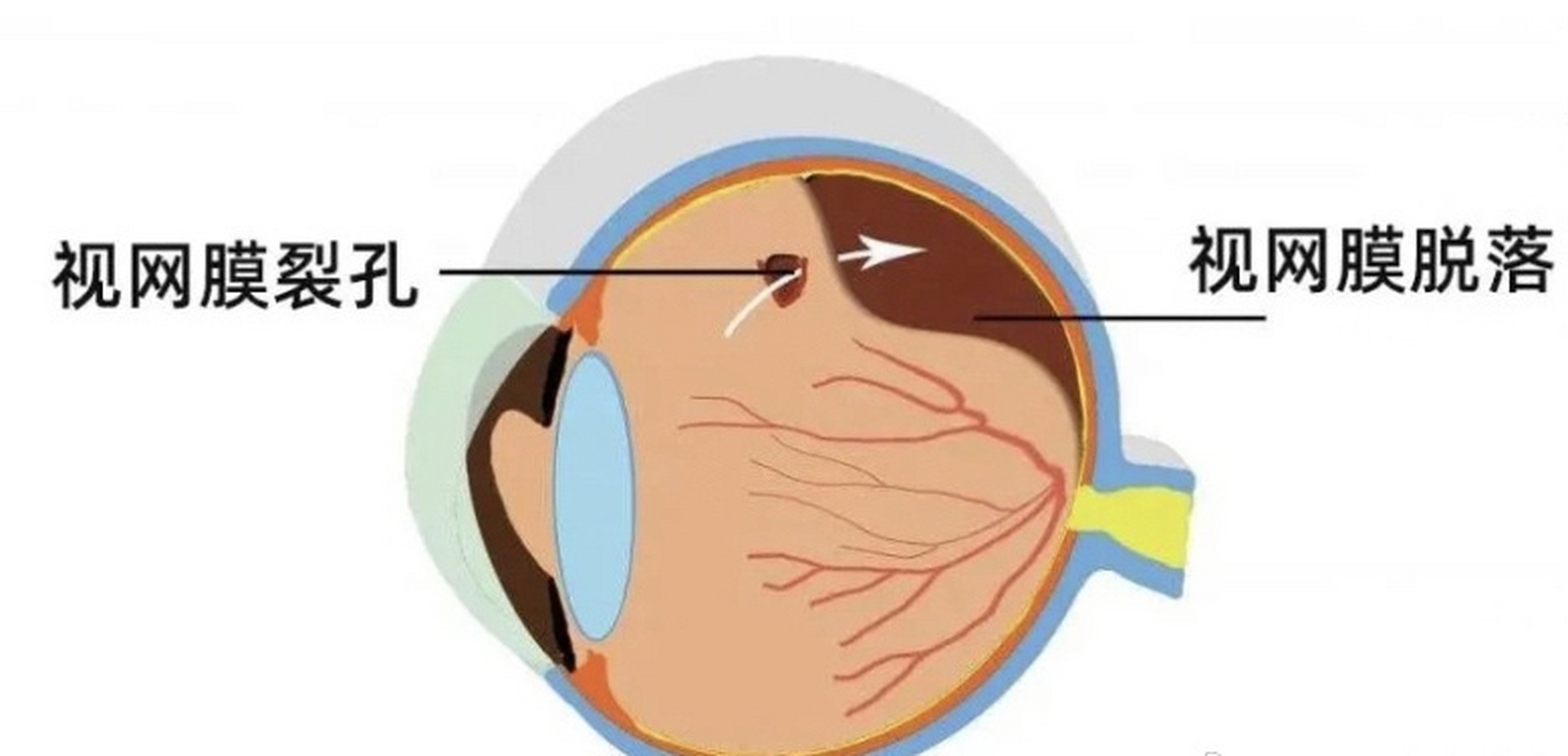 视网膜脱落照片图片