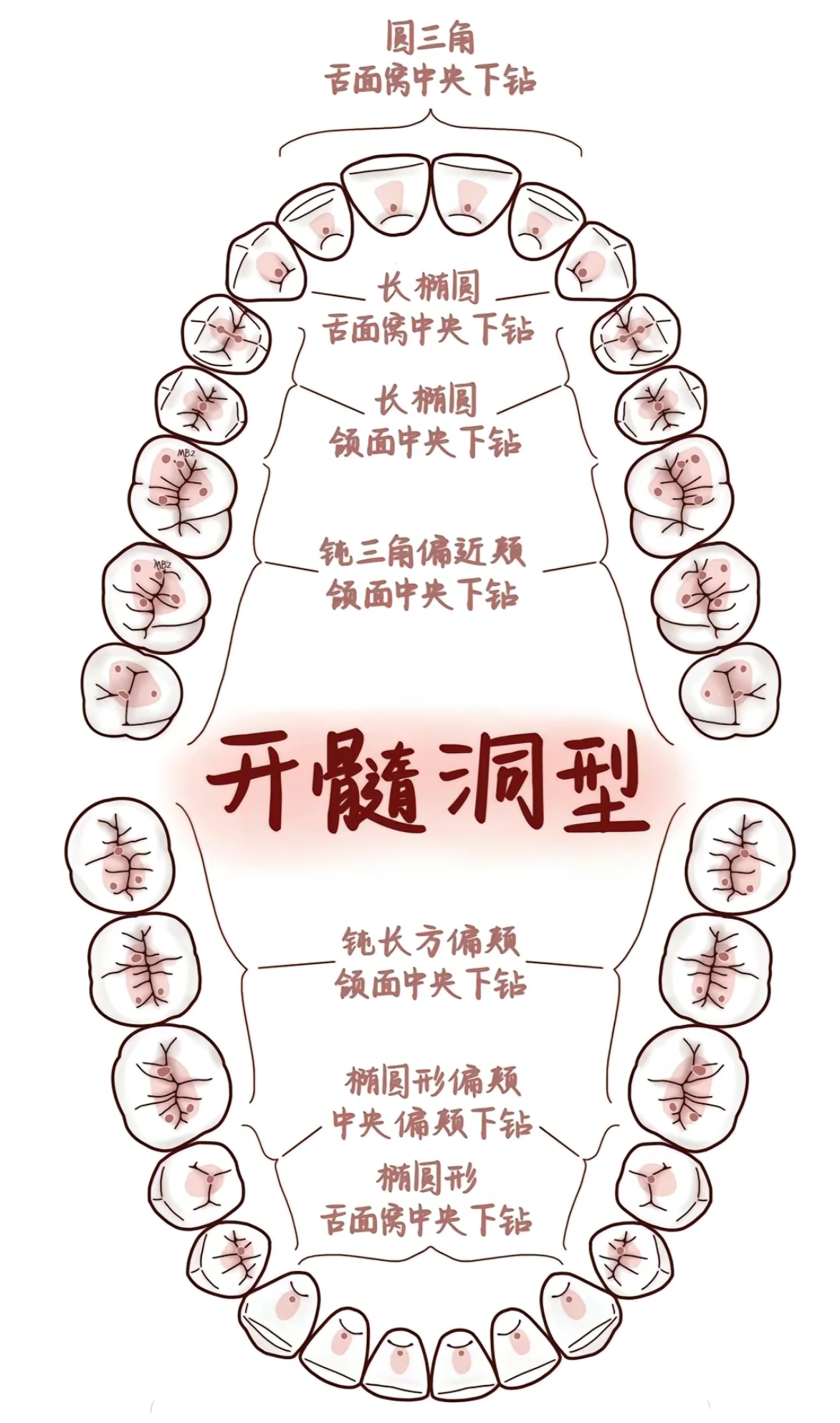 牙齿保护站# 牙医才能看懂的牙神经分布图和开髓洞型,精准的麻醉在