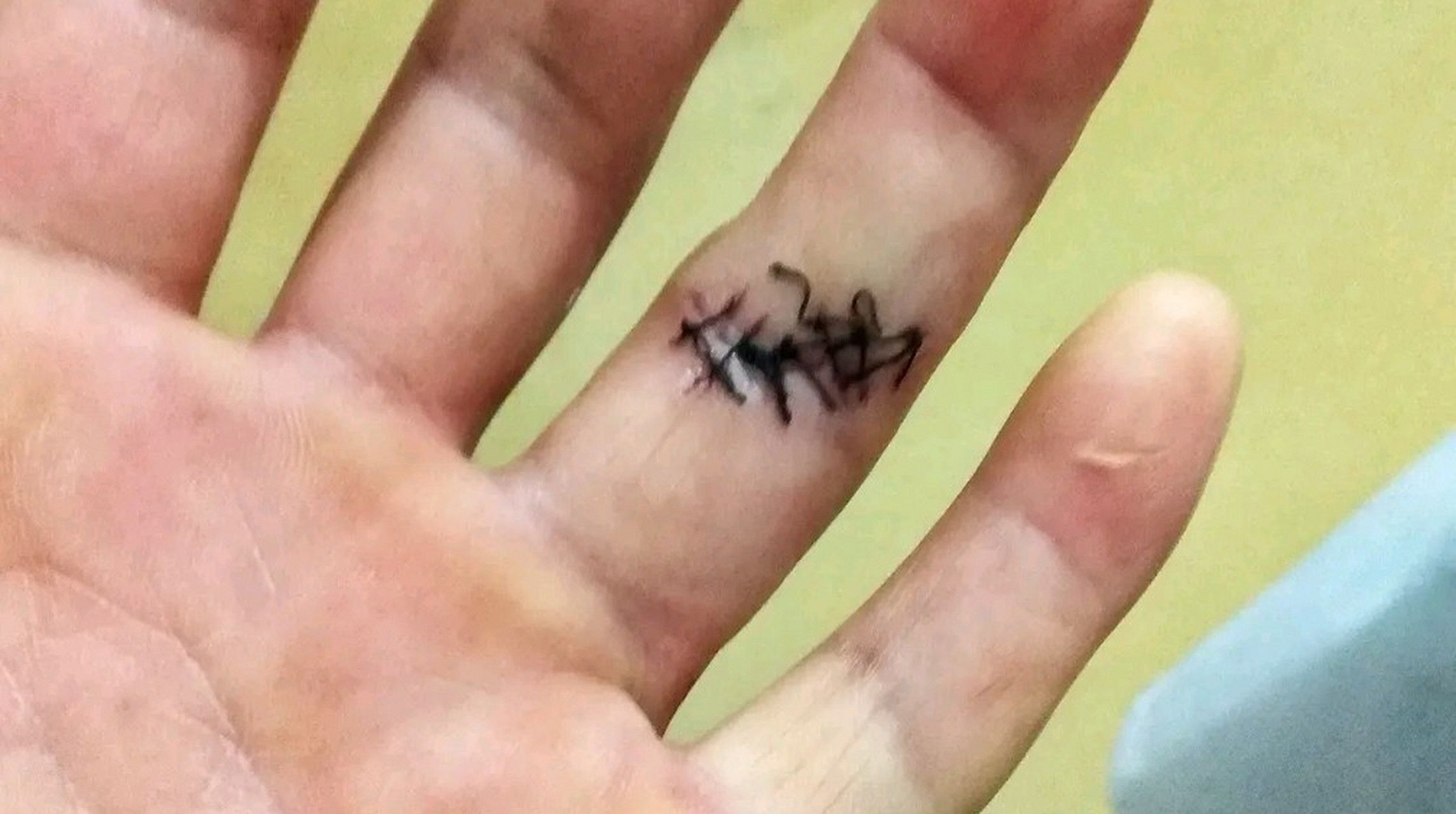 网友爆料前几天不小心割到手,就一个小口子,但流血不止,去诊所 医生说