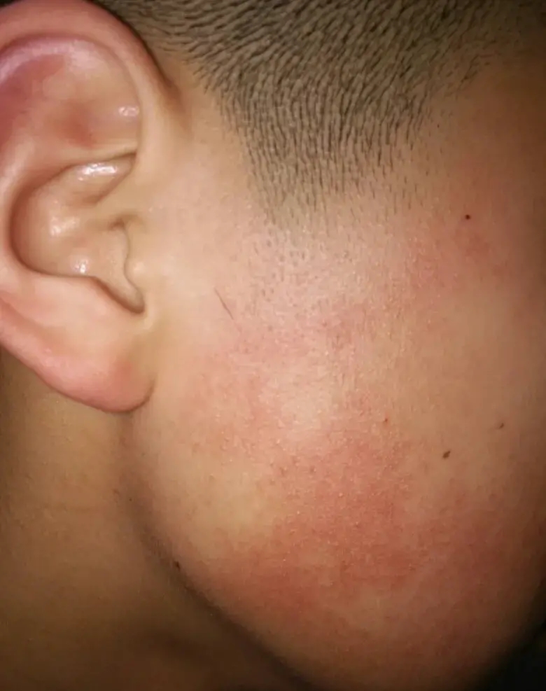脸颊两侧毛周角化小孩脸颊两侧皮肤发红图片脸颊长一小块一小块的是