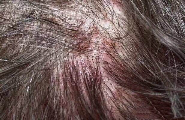 从脱发到毛囊坏死,你不得不了解的毛囊知识!