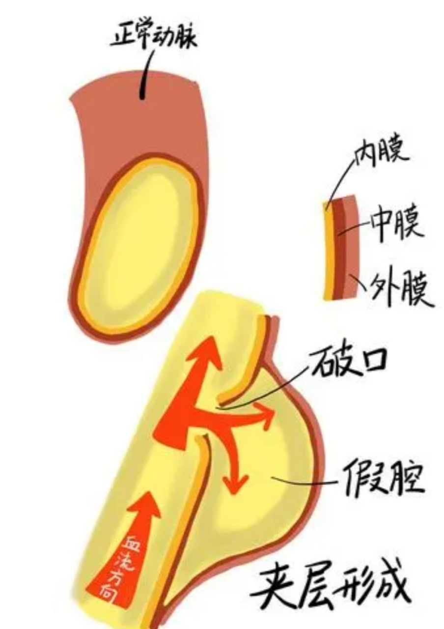 四大高危胸疼,别忽视来势汹汹的主动脉夹层带来的危害.