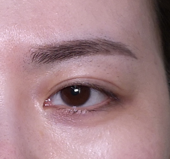 双眼皮手术做扇形好还是平扇好?