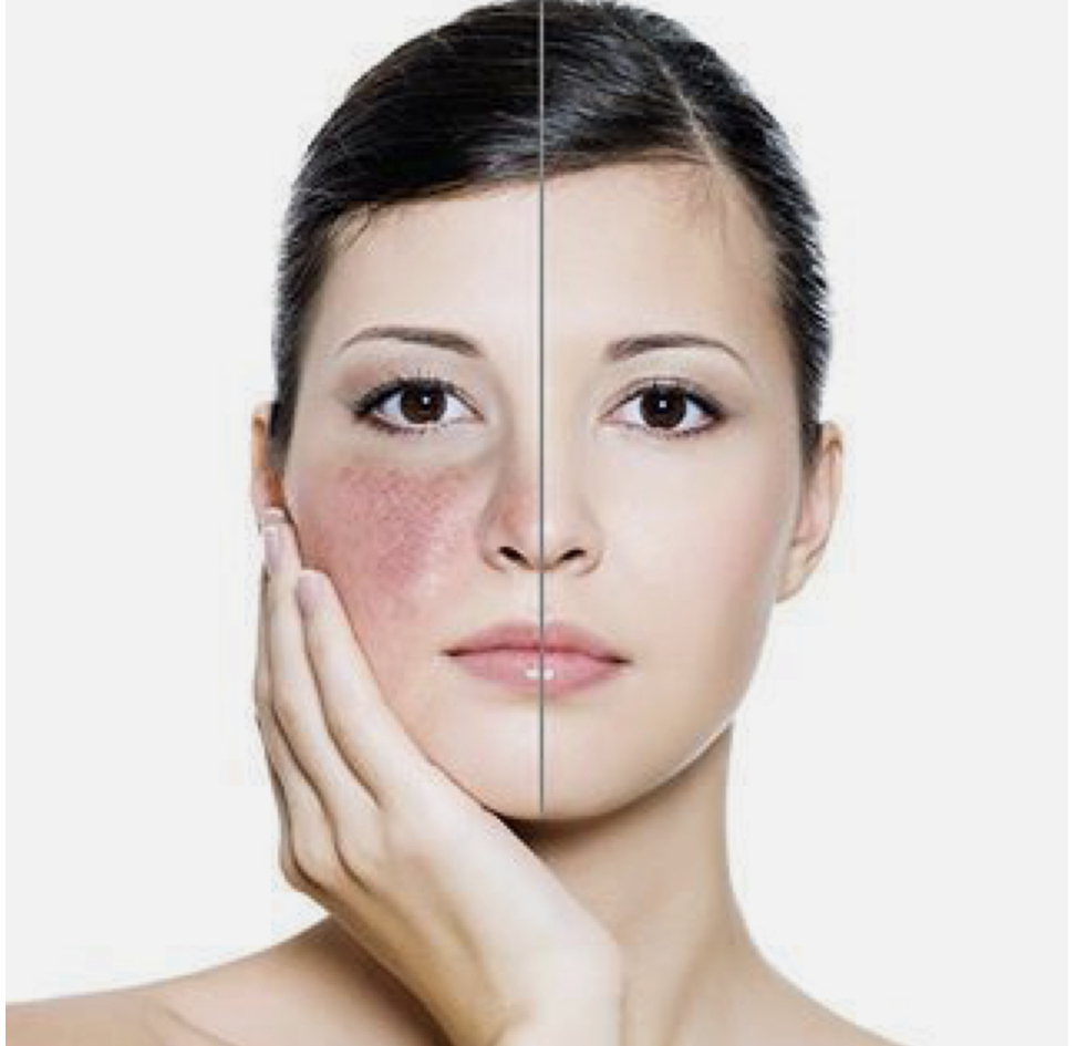 洗完脸干如何确定是换季皮肤敏感,还是肌肤屏障受损?