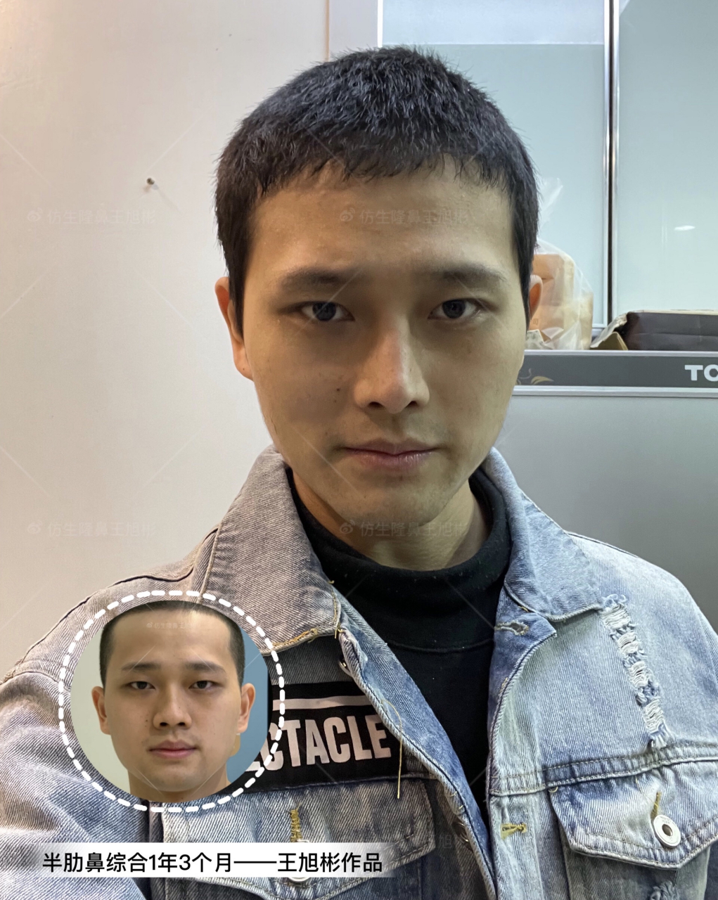 【北京网红帅哥的"月亮脸"改造|王旭彬鼻整形】 颌