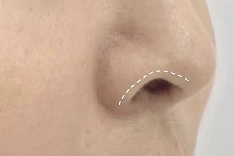 隆鼻手术后,鼻子居然挛缩了?