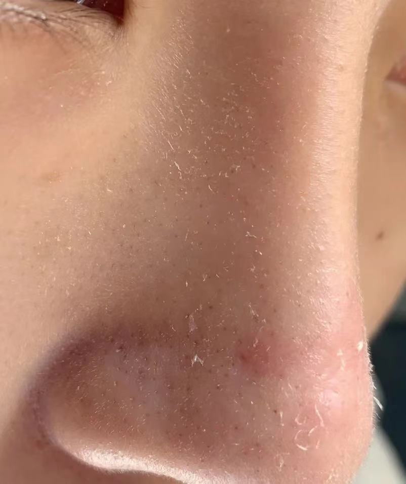 鼻子起皮后妆前应该怎么急救?