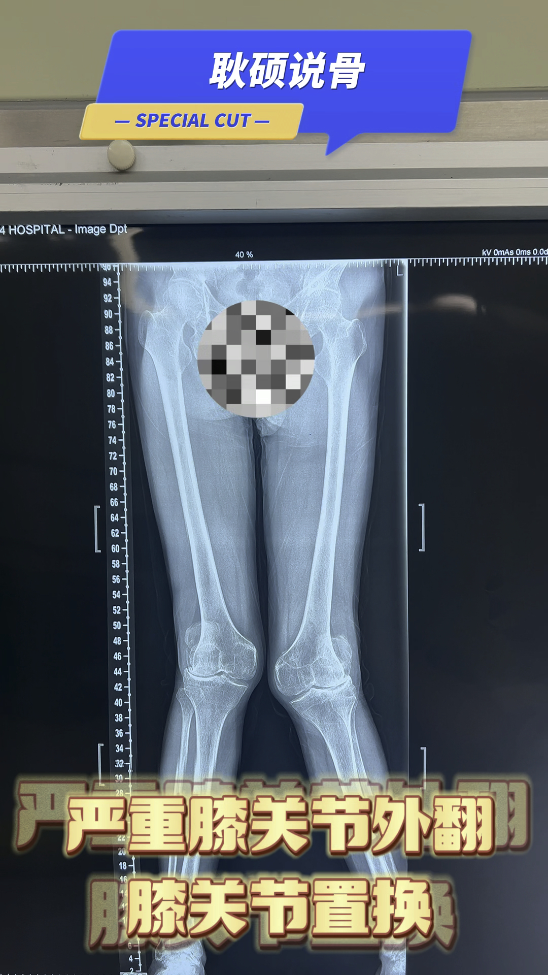 严重外翻膝关节畸形,走路困难,行走困难,膝关节置换