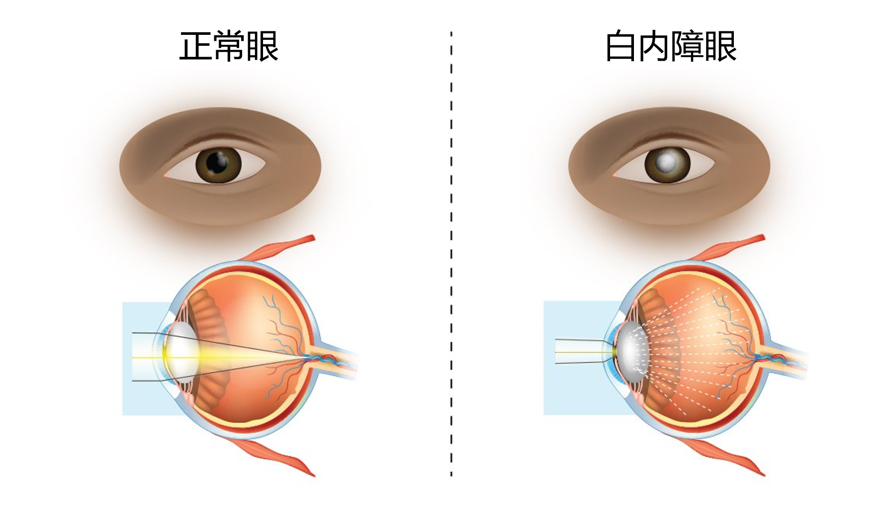 白内障示意图图片