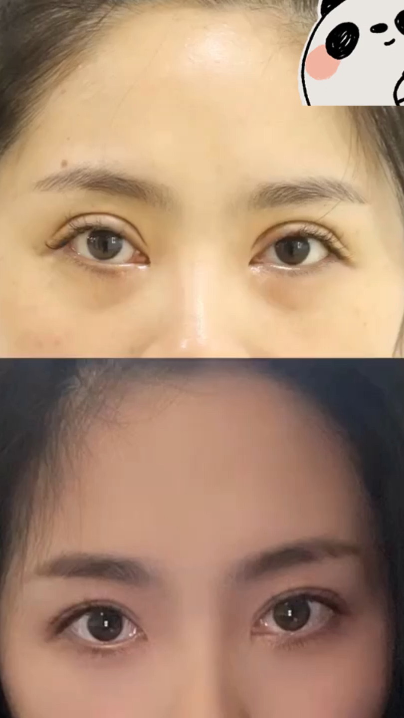 两个月的恢复过程修复前的情况是:双眼皮内侧宽,肉条感明显,修复之后