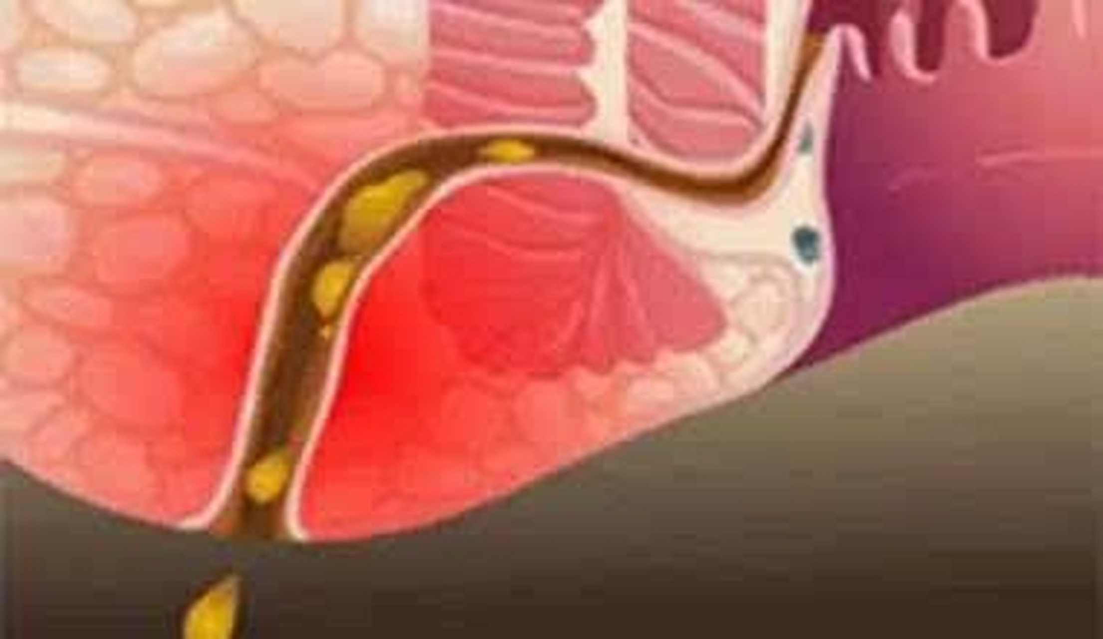 "大夫,一个月前,我突然发现肛门旁边长了一个硬块,后来变大变软,摸让