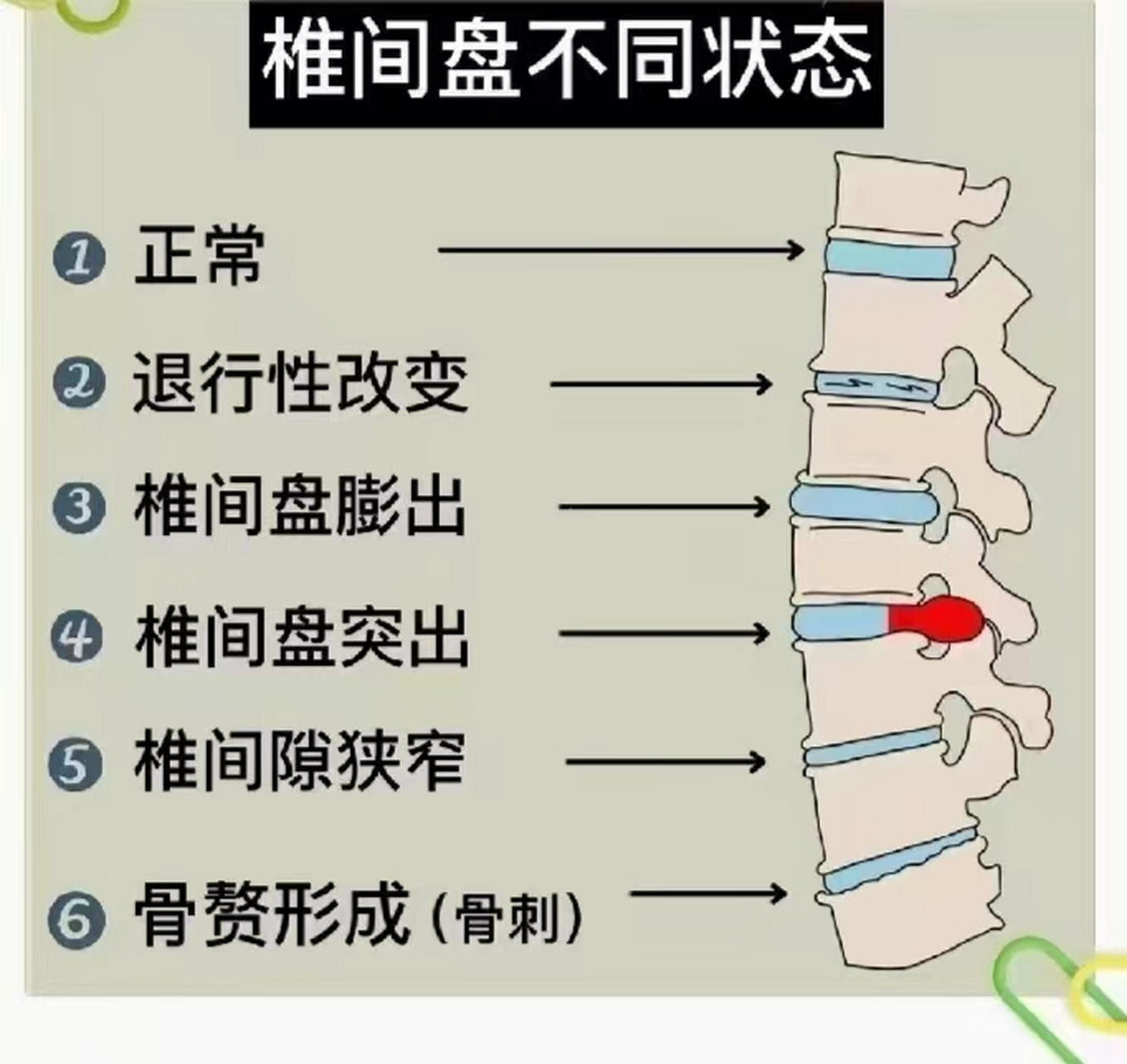 一張圖看懂椎間盤上的損傷病變[石化] 正在彎腰或者癱著的你,快來調整