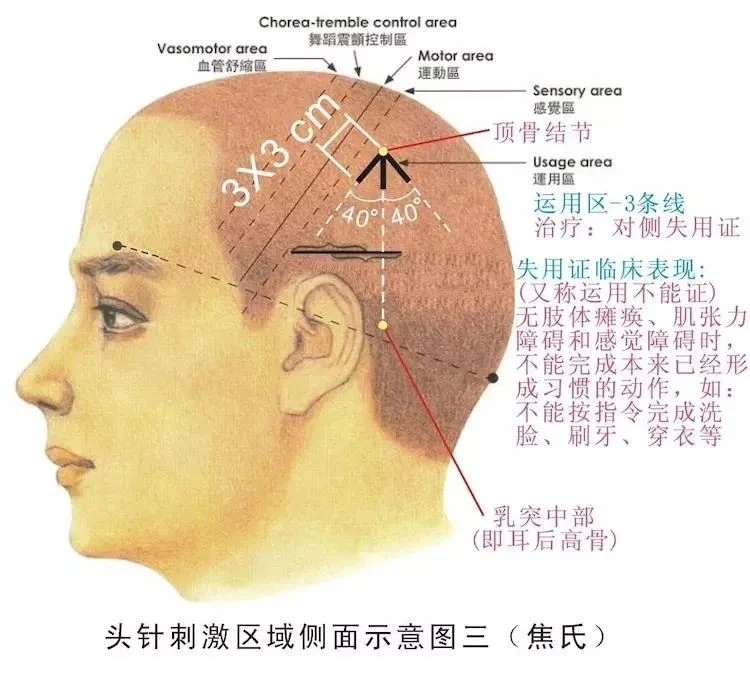 头针疗法详解