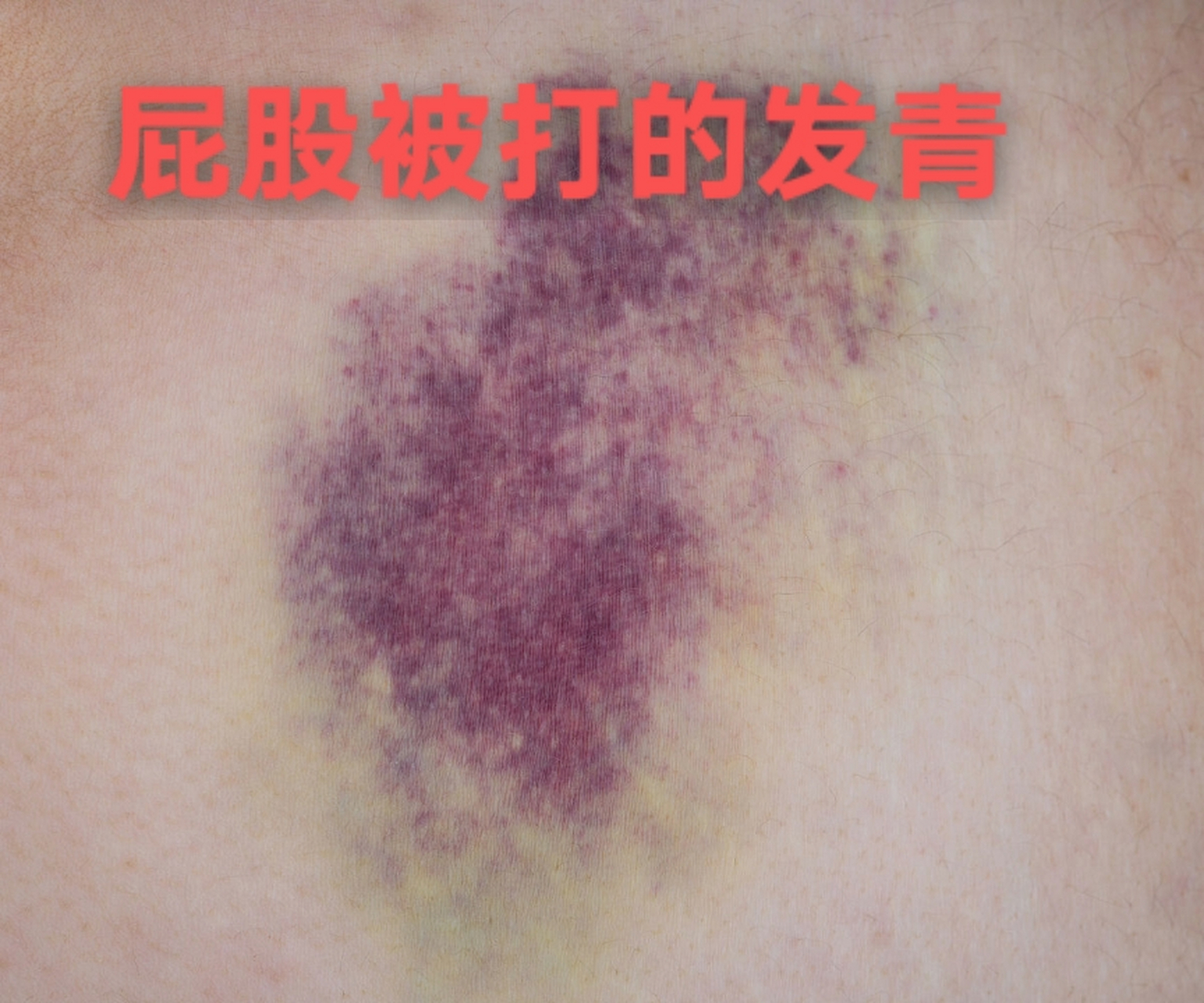 被班主任打了几下屁股,导致屁股青紫