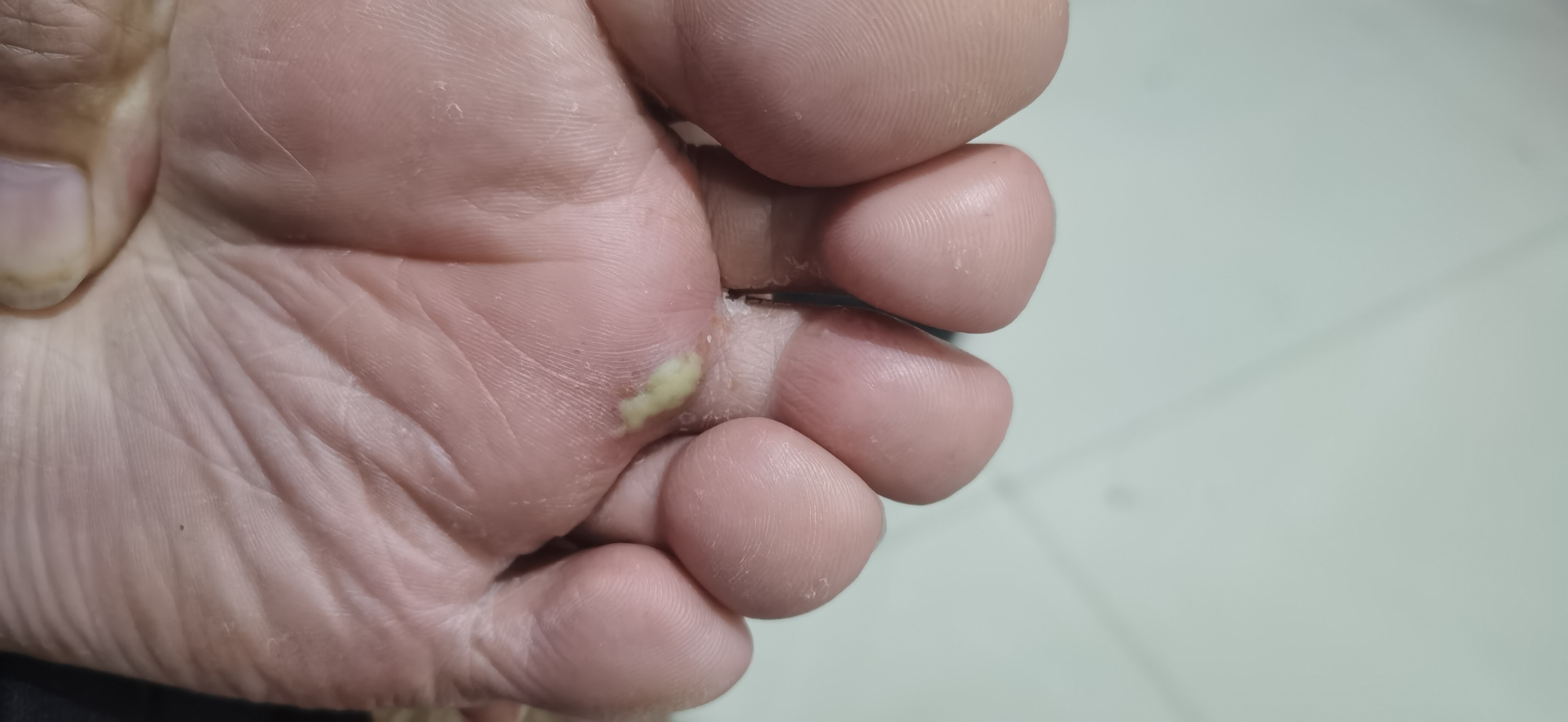 周一的脚起泡因为自己的酒精处置方案未能对症,走路感到疼痛,担心事态