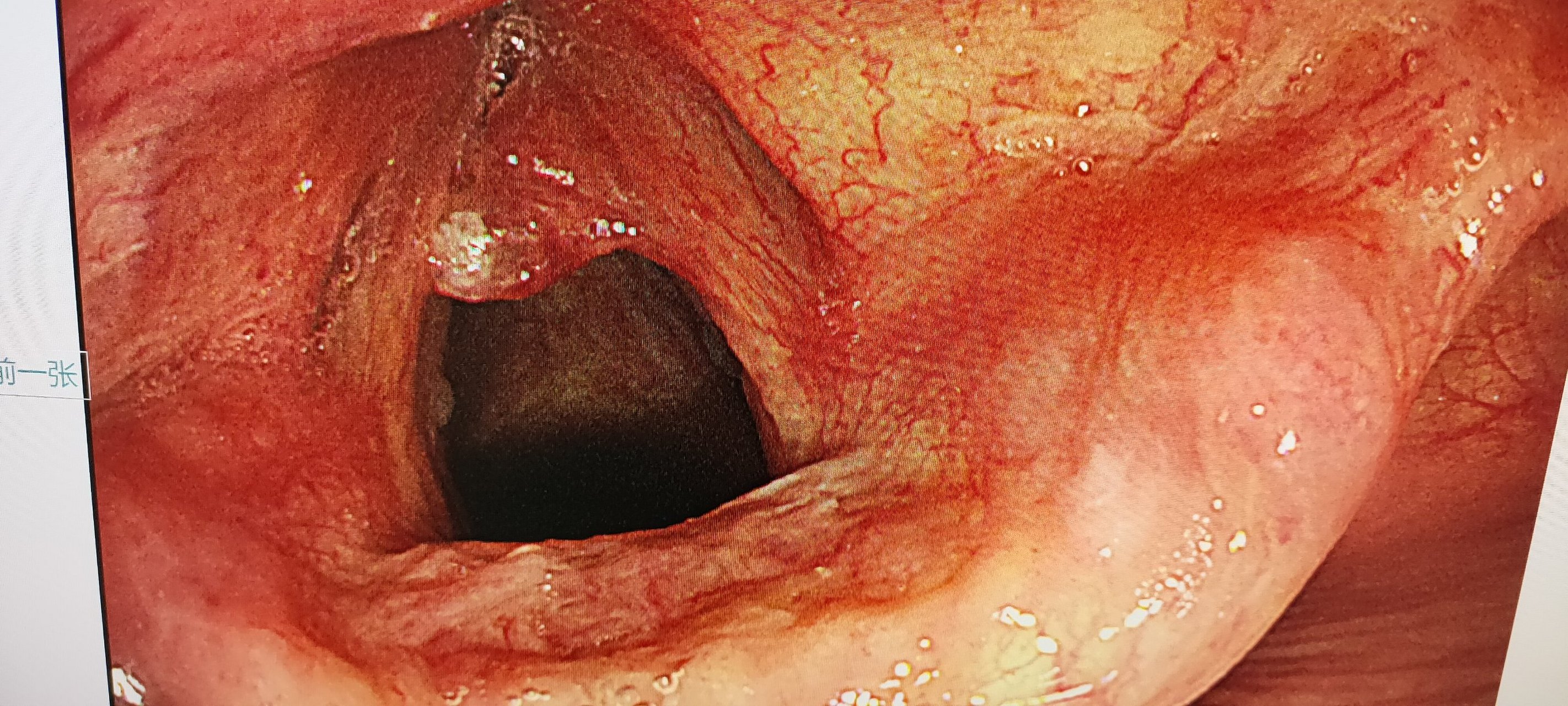 声带息肉吗 今天胃镜观察咽喉部发现的一个小东西,这是个啥?