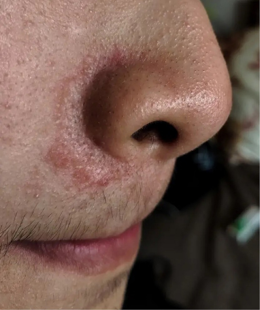 鼻唇沟的红斑鳞屑,时有瘙痒,这是脂溢性皮炎,好像有这个病的年轻人