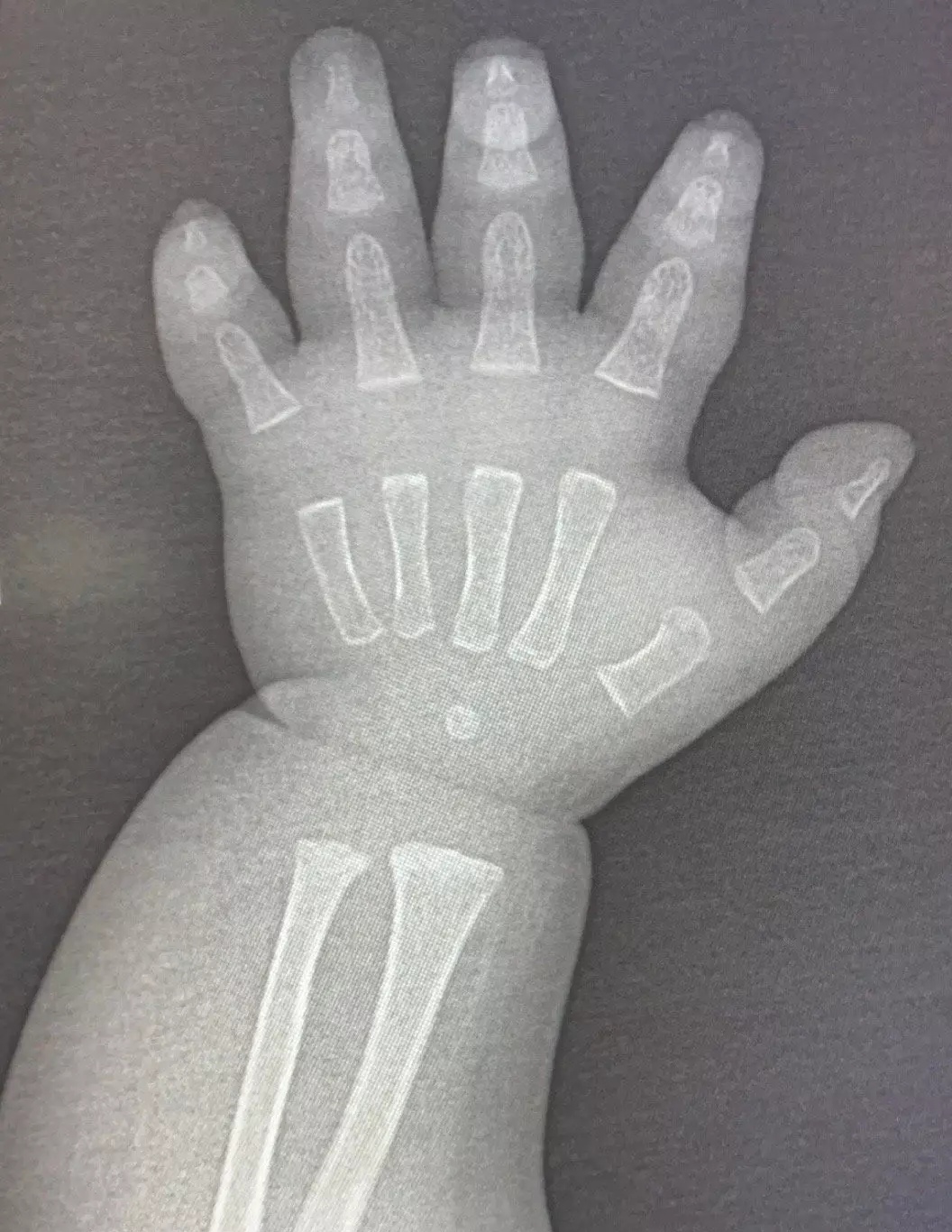 X光片婴儿图片