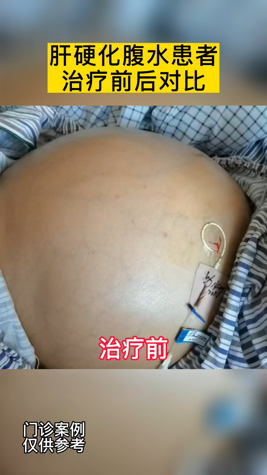 同一患者入院时,治疗后对比,病情好转,腹水明显减少,明天出院!