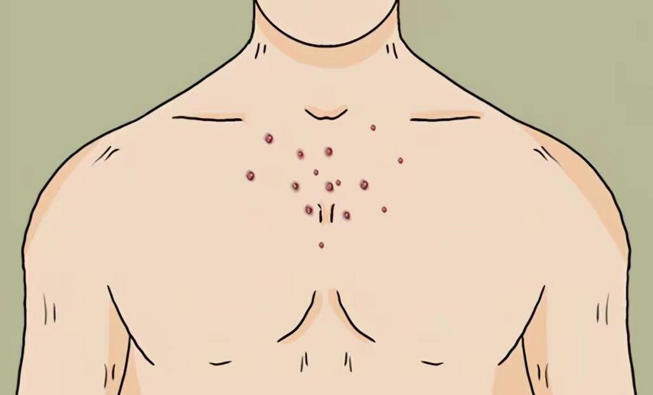 杭州皮肤科:毛囊炎怎么治疗?