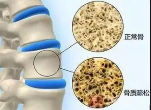 怎么判断骨质增生图片