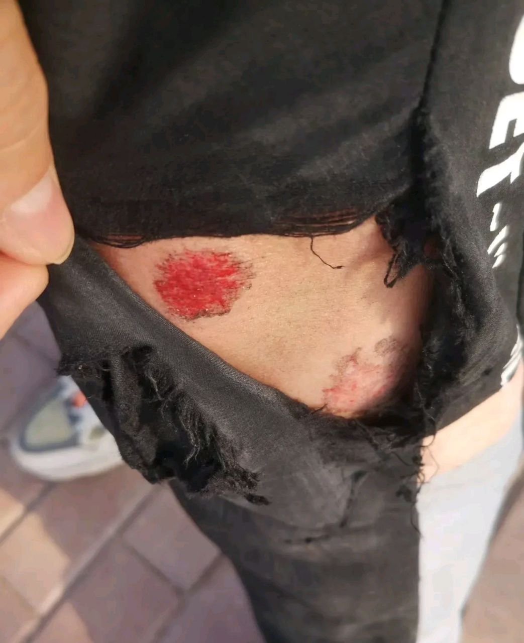 被一个60岁的老人阿姨骑电动车撞到了,裤子破了大腿直接流血了,报了