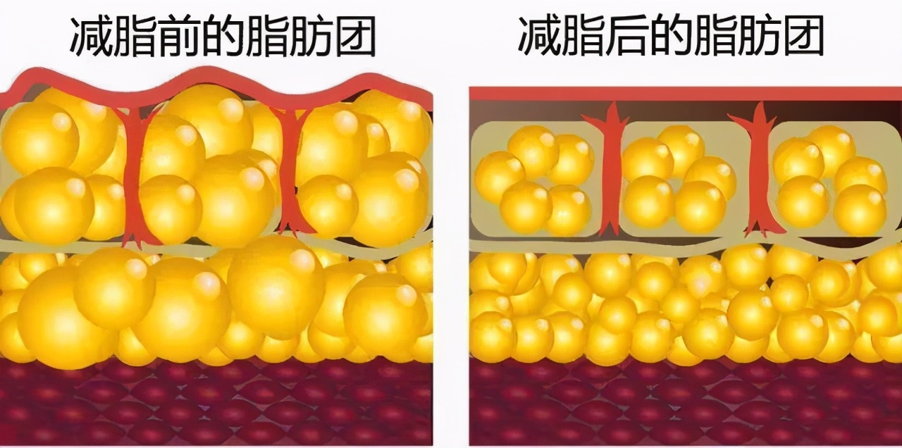 脂肪堆积图图片