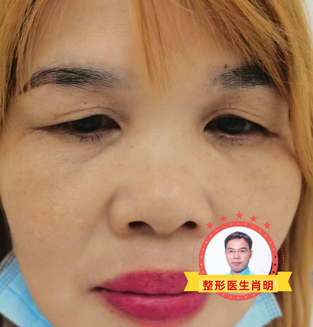 眉下切口提眉可以让人年轻很多哦