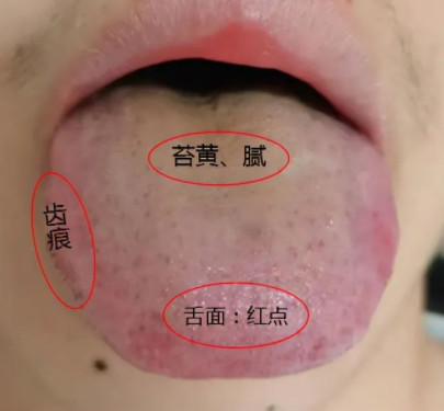 苏州御生堂:舌苔厚腻,是疾病发出的信号!