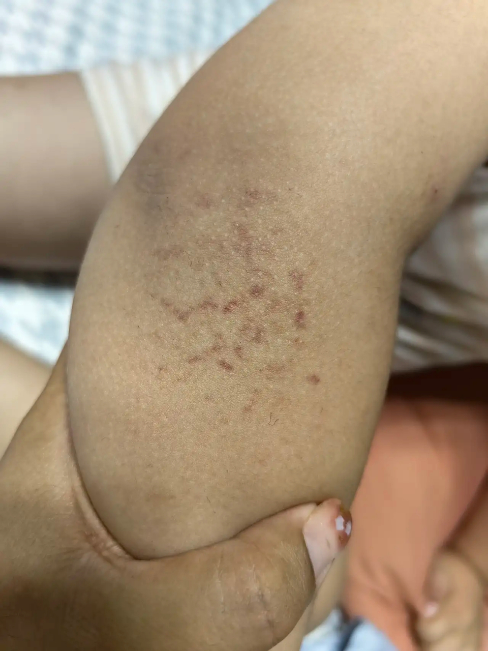 亲们知道这是什么吗 是出血点吗 是在皮肤里面 没有凸出来 而且很奇怪