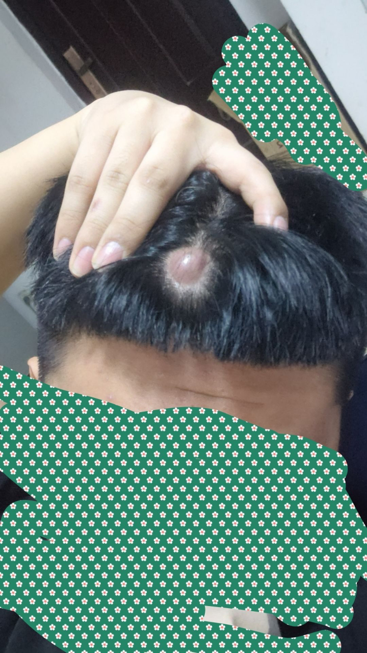 头顶长了个摄像头,不痛不痒怎么办?