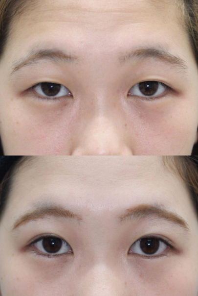 吸雕双眼皮手术有哪些优势?要选择适合自己的双眼皮手术