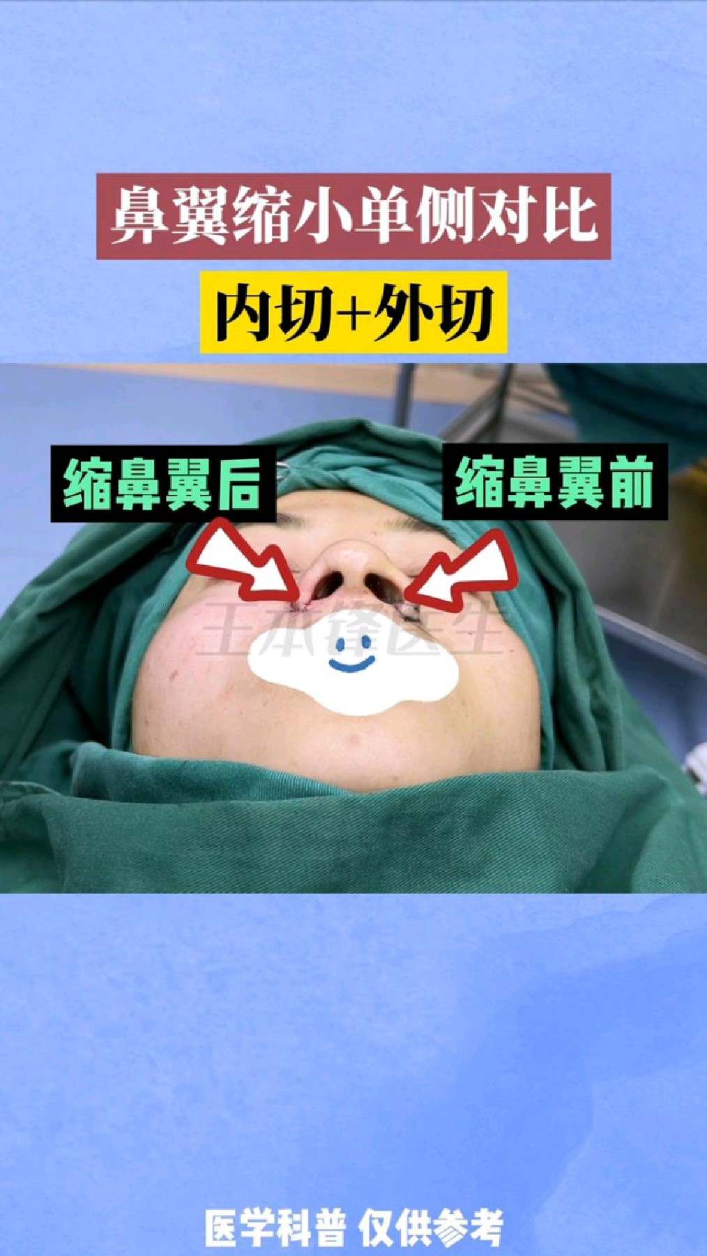 很多粉丝问的鼻翼缩小这例内切外切分享给大家