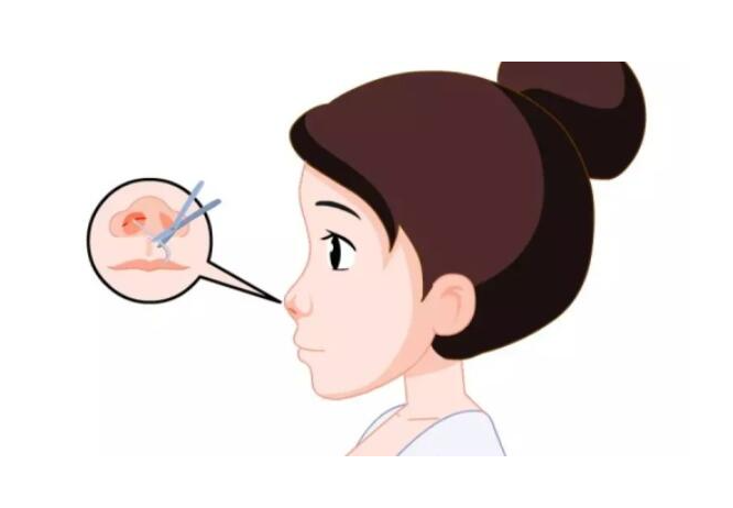 鼻孔缩小术有后遗症嘛?