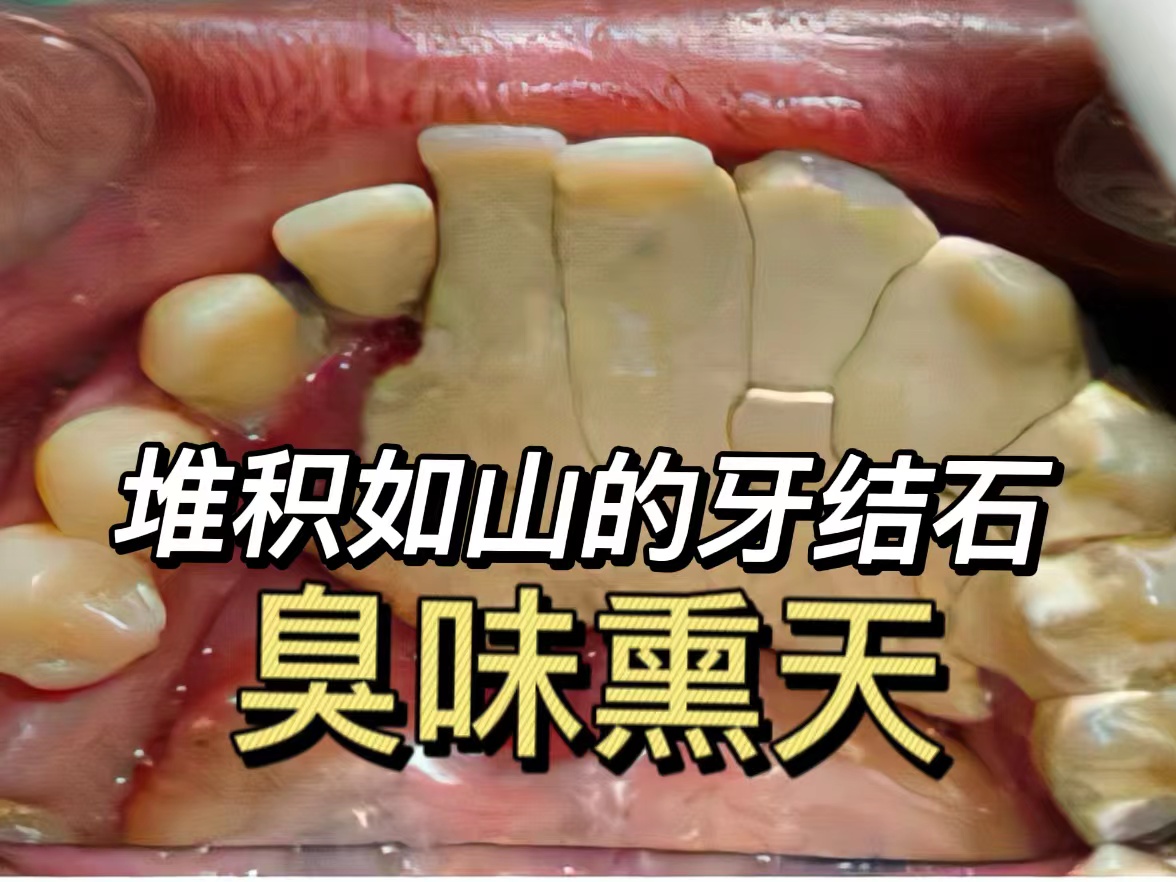 牙结石"臭"名昭著好尴尬?学会这三招,快速拥有清新口气!