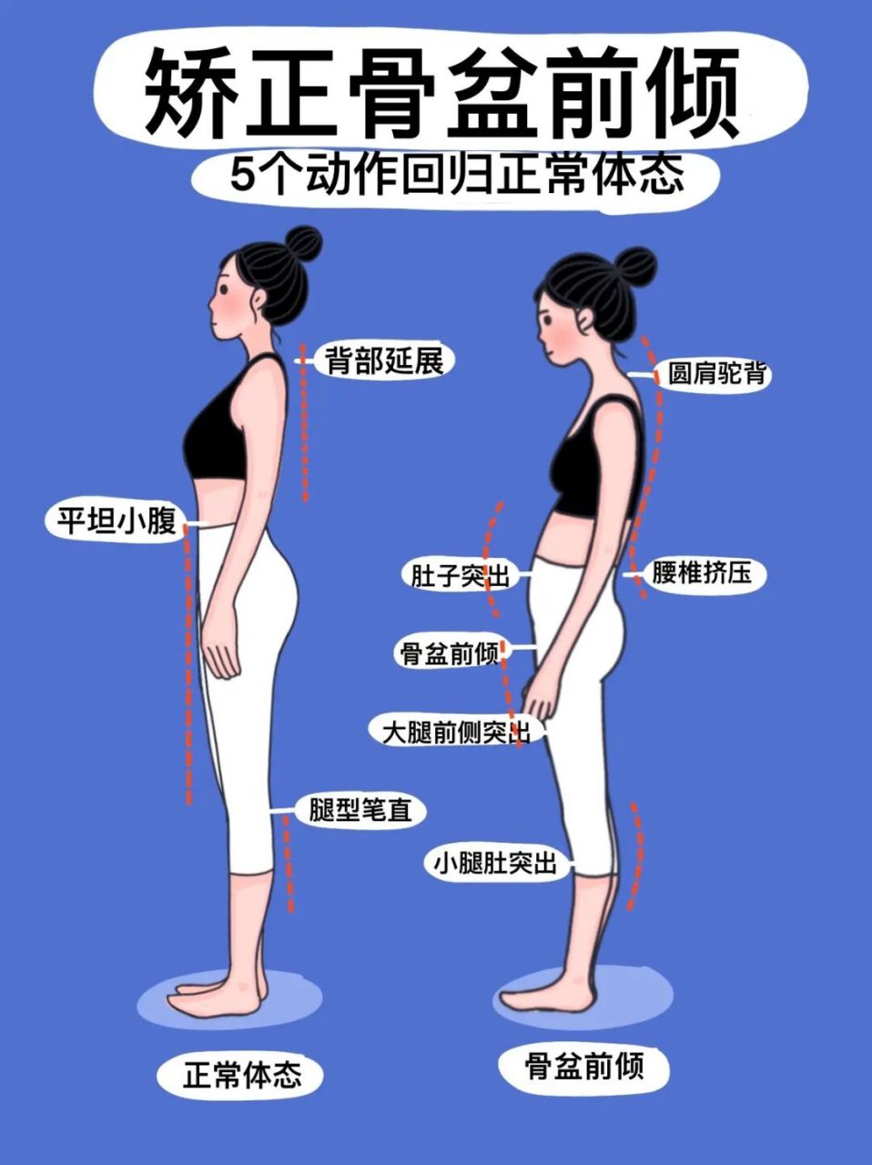 矫正骨盆前倾|4个动作回归正常体态