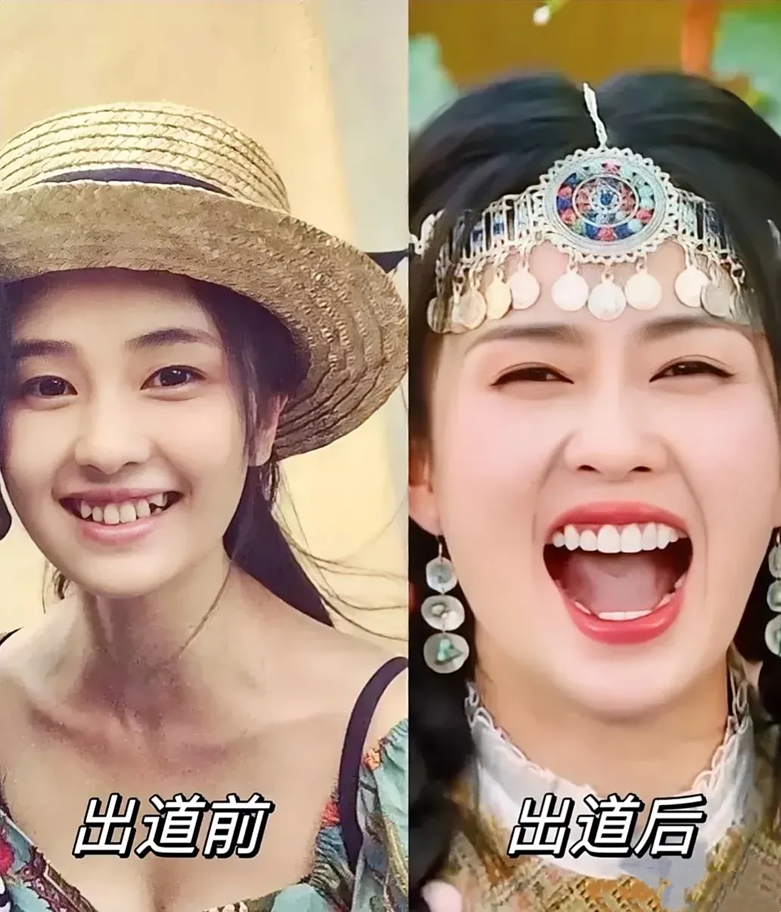 白鹿在出道前是有着可爱的小虎牙,非常有辨识 度,但美中不足的是牙齿