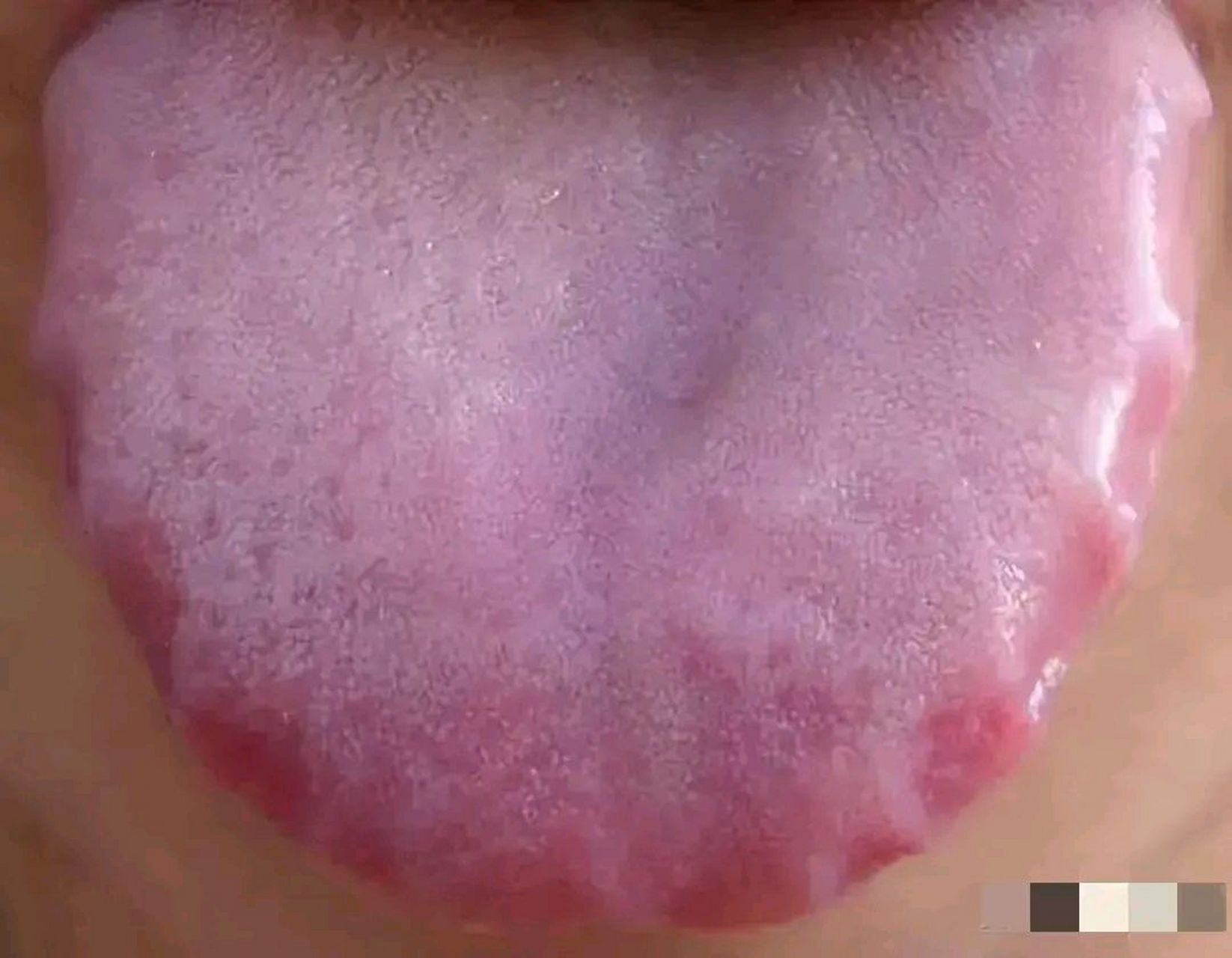 不死的癌症,齿痕舌!