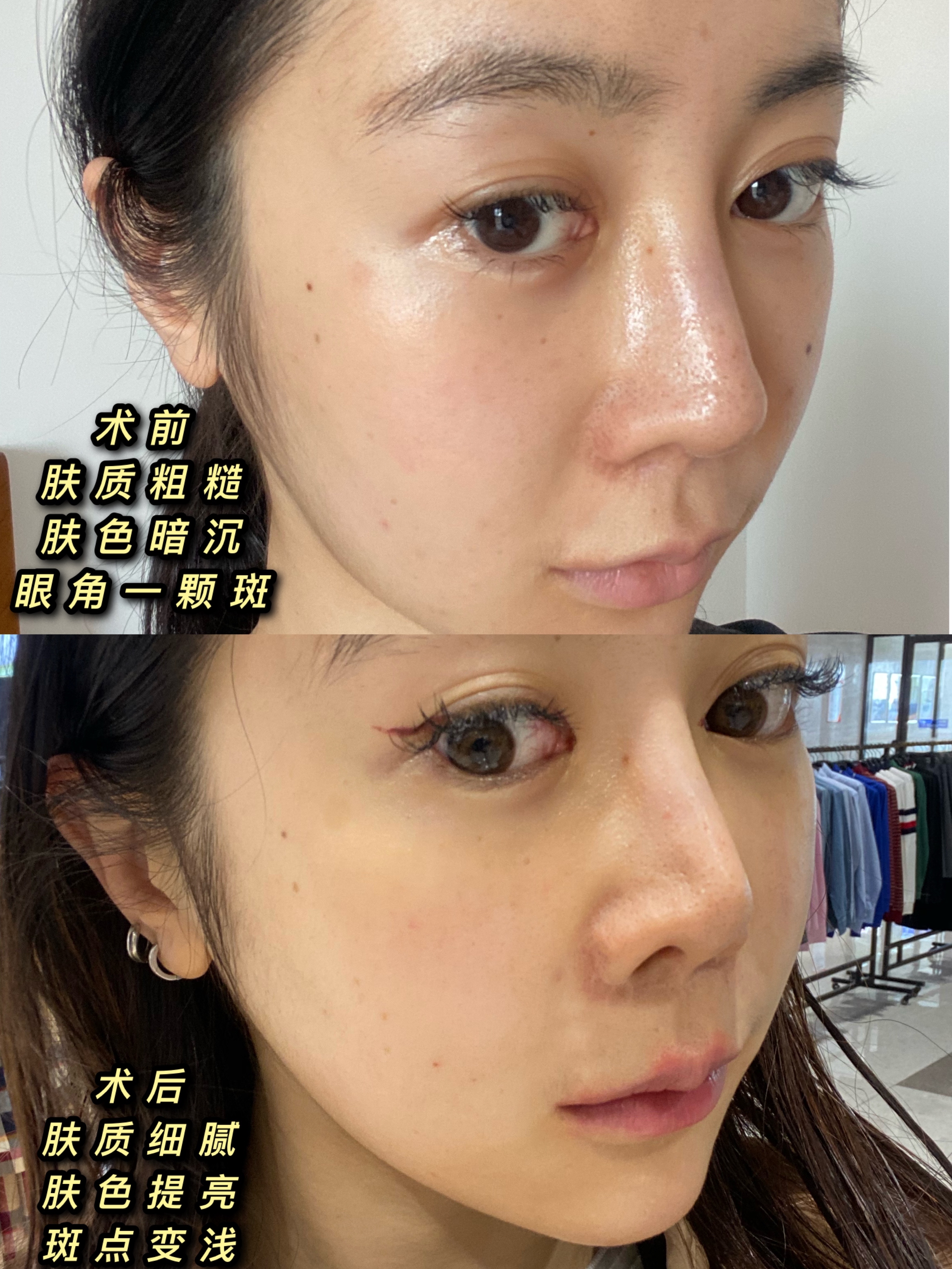 个人诉求 美白提亮抗衰t区毛孔粗大需改善脸上有几颗斑及痘印