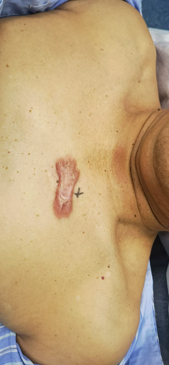 胸前瘢痕疙瘩的疤核掏切手术,为避免复发和减少创伤,保留疤痕边缘皮肤
