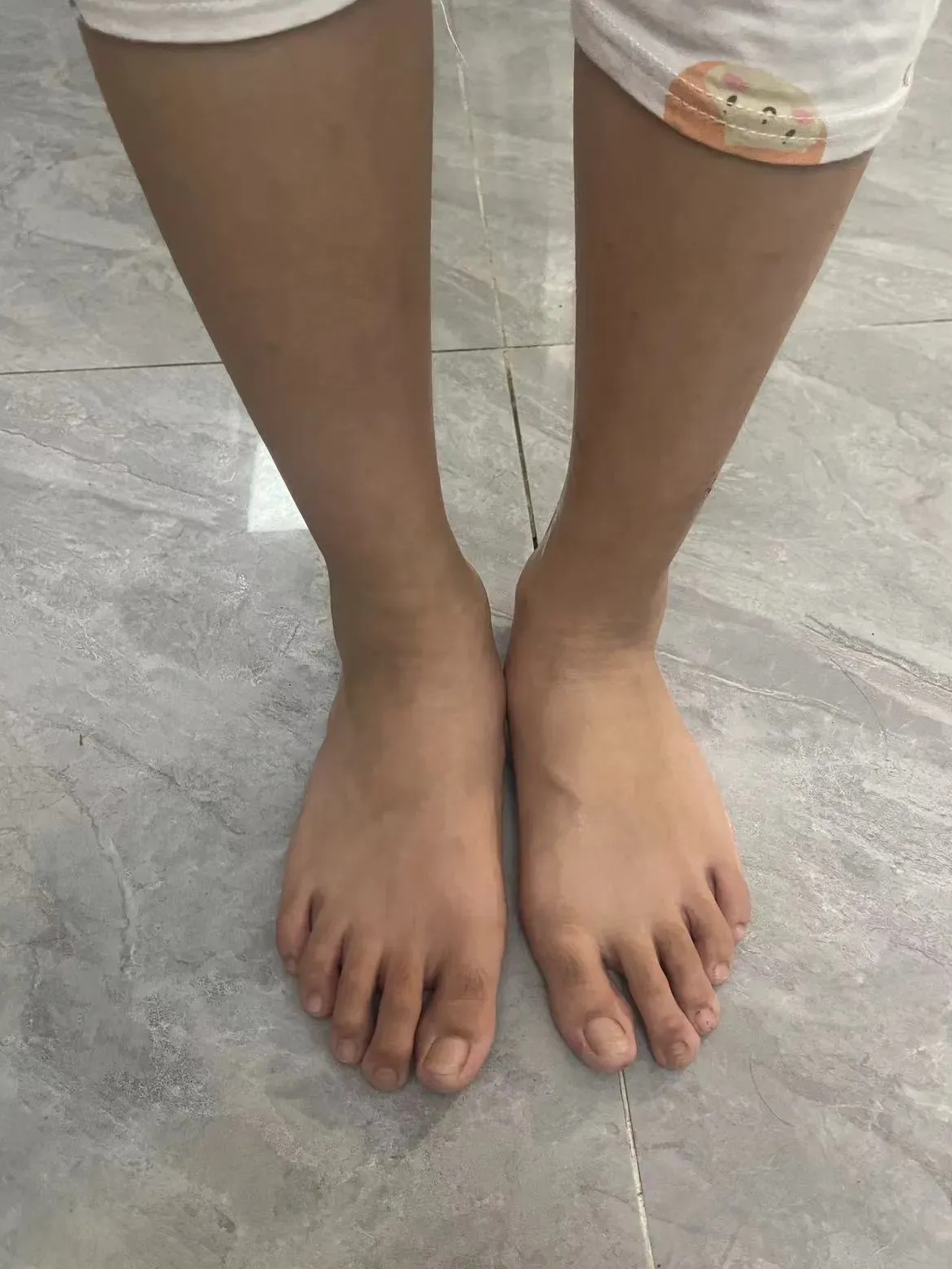 这孩子的足外翻因为长期脚心和足部内侧负重为主,拇趾也被影响,出现