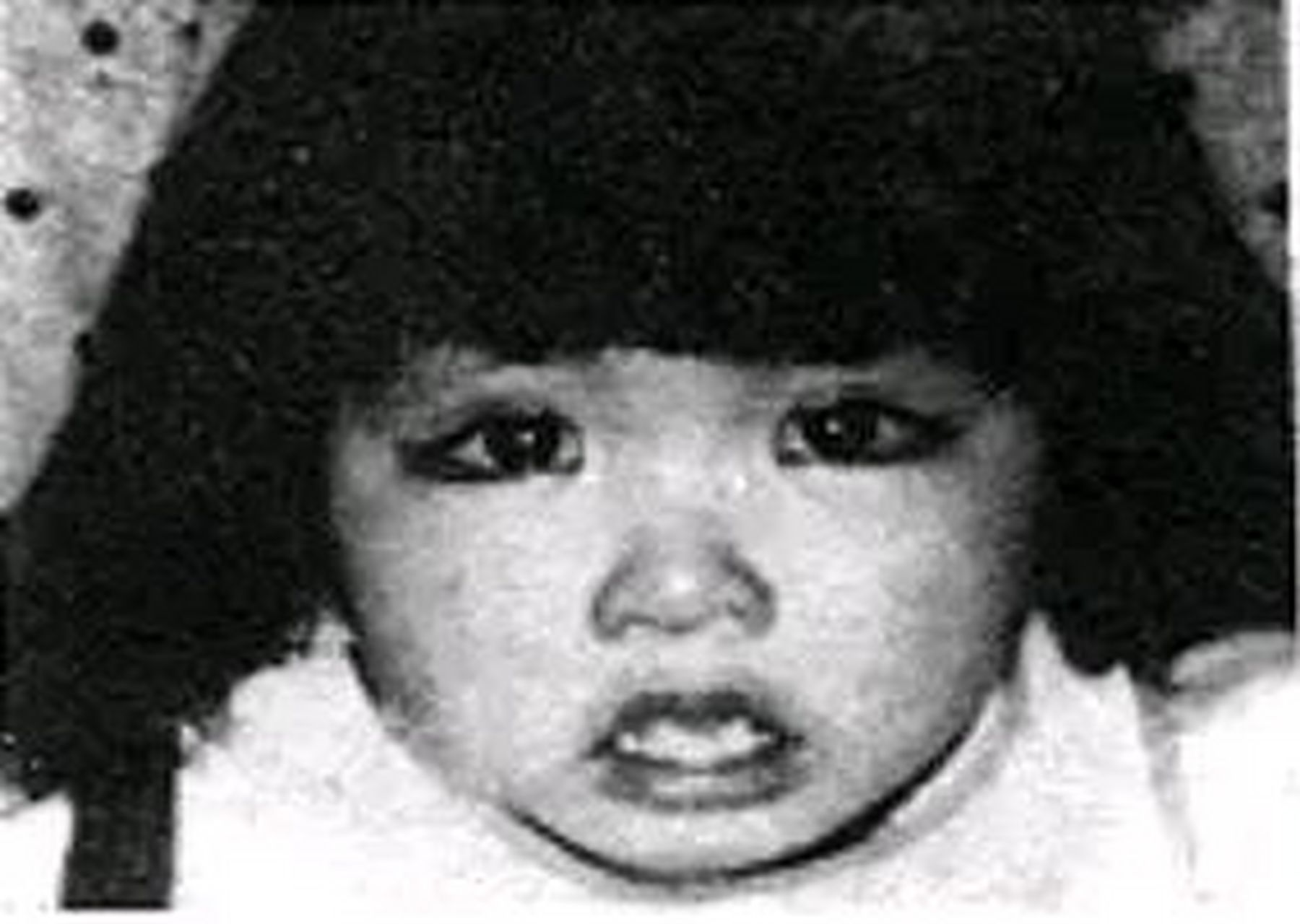 "歌舞伎综合征",你听说过吗?