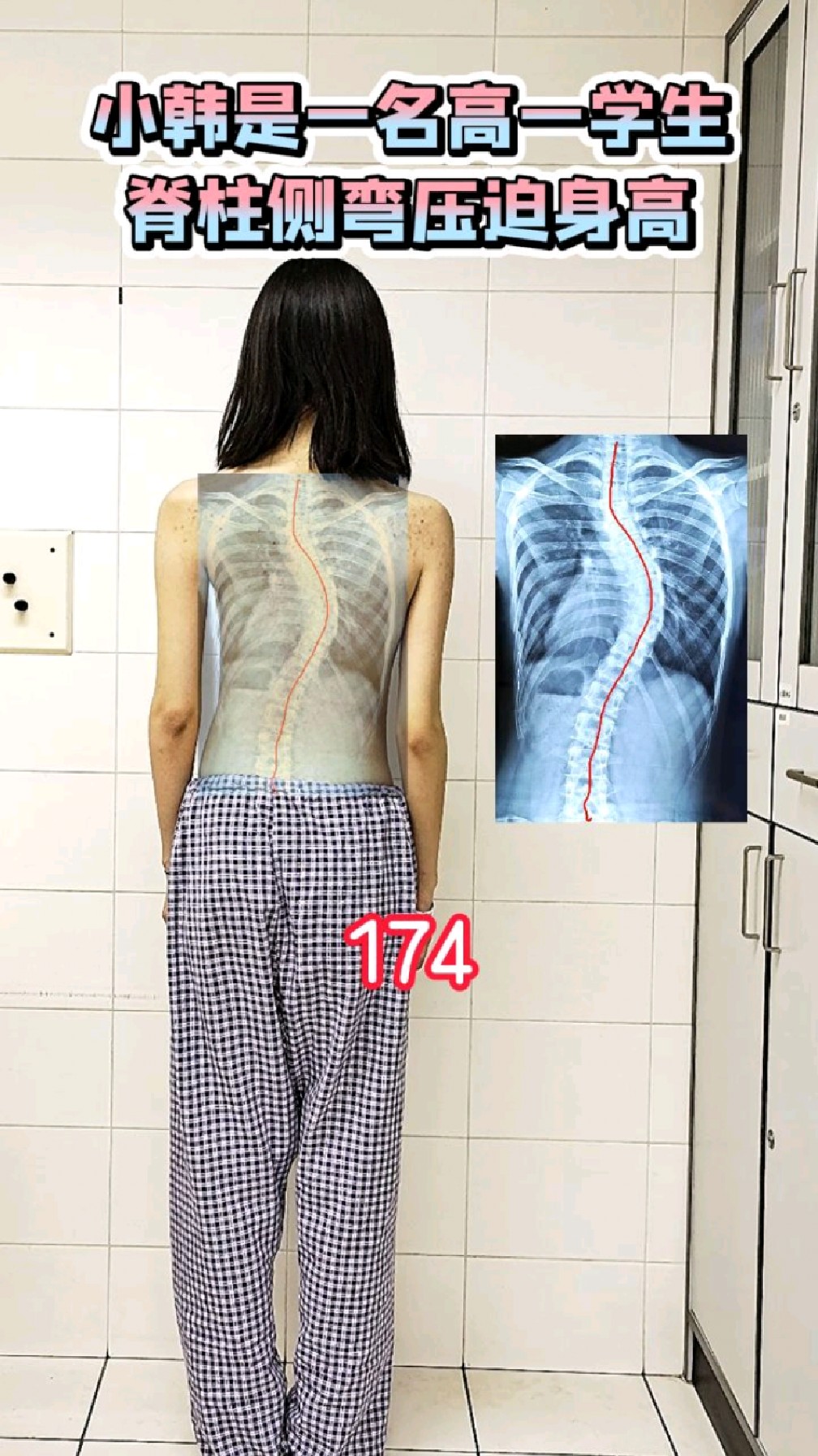 高一女孩174㎝,"拉直"脊柱侧弯后,能有多高?