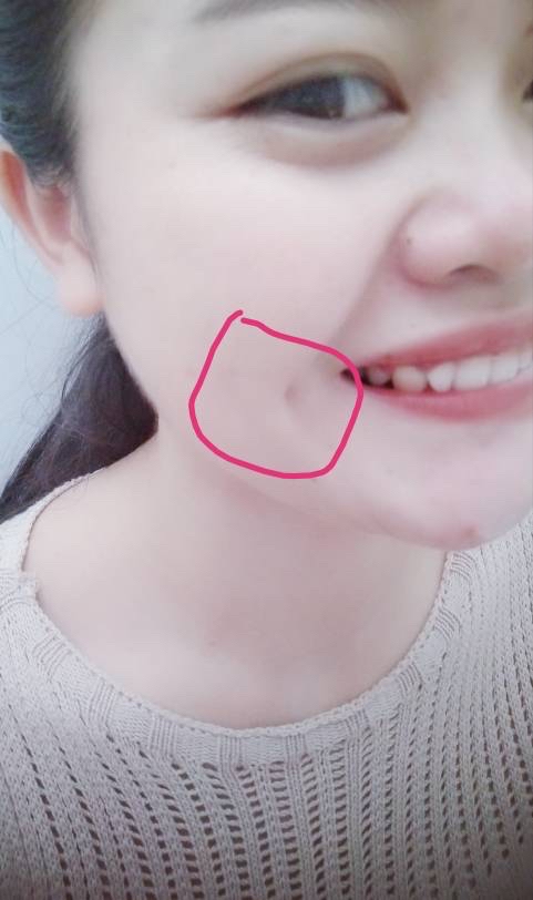 酒窝和梨涡的区别是什么?酒窝成形术如何操作?