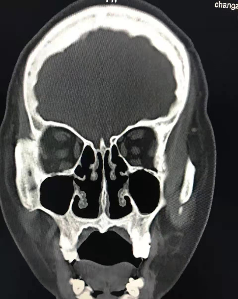 窦口鼻道复合体CT图图片