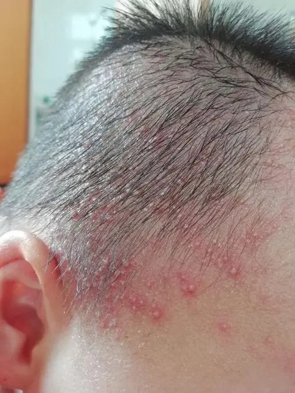 才五月的天气,小侄子的脸上头上已经长出了很多热痱