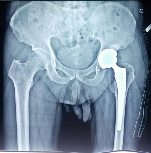 如何预防和治疗髋关节置换术后松懈?